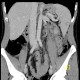 Celiac disease, foamy content of jejunum, CT enterography: CT - Computed tomography